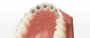 裏側治療で見えずに前歯だけの矯正部分矯正