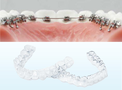 透明マウスピースと裏側の見えない歯列矯正｜神戸三宮の矯正歯科