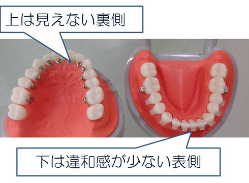 裏側矯正 × 表側矯正歯列矯正を半分ずつ装着で快適な歯並びを